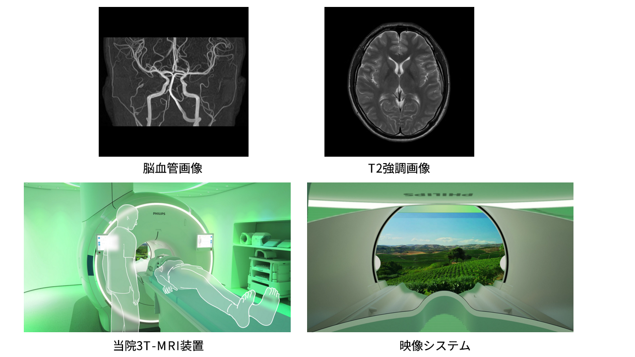 写真：脳血管画像の比較